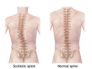 scoliosis